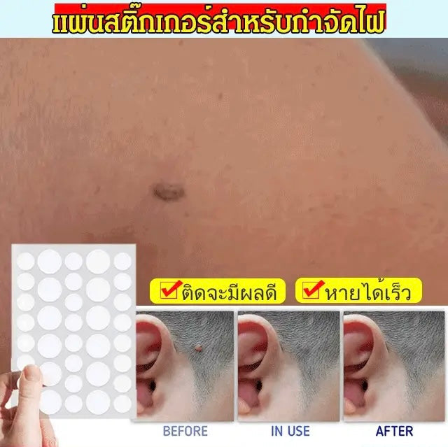 لاصقات تجميل صغيرة للبشرة | لاصقات إزالة الشامات المخفية